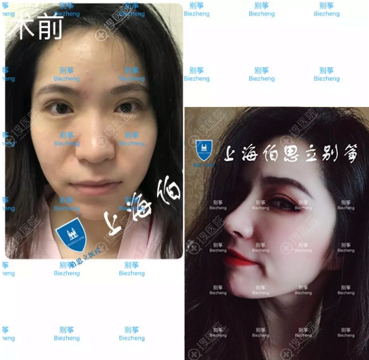 上海伯思立别筝做的半肋鼻综合修复案例 上海伯思立别筝做的半肋鼻综合修复案例