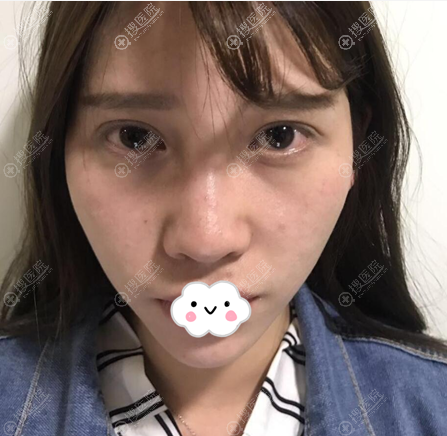 来听听我找重庆百达丽黄伟光做脂肪填充额头太阳穴的经验之谈