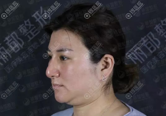 给你们看看我刚在昆明丽都医院做完双下巴吸脂的效果怎么样吧
