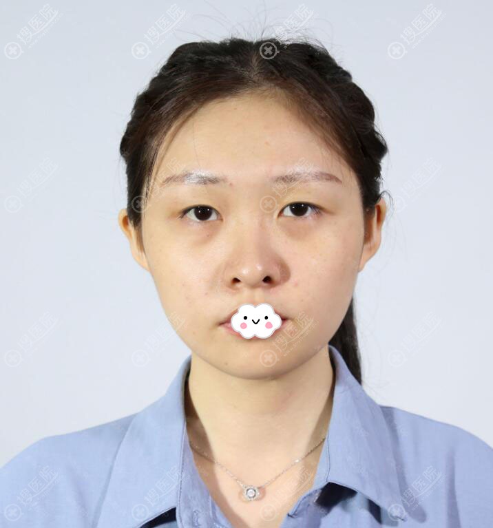 考虑价格合理找广州曙光范丹做切开双眼皮开眼角还改变上睑下垂