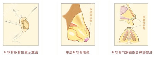 奉上自体隆鼻材料优势和价格,给你一个没有假体的天然“真”鼻