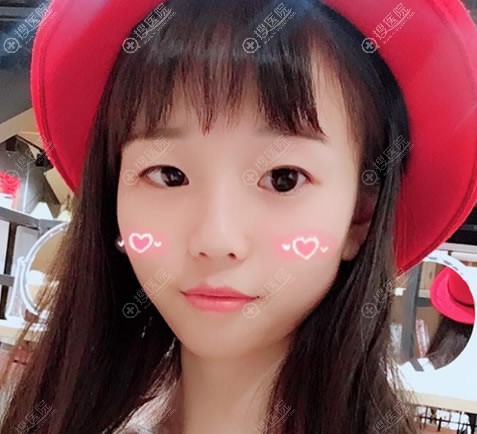 找南京亚韩医院贝怀年院长做双眼皮和开眼角3月达到预期效果