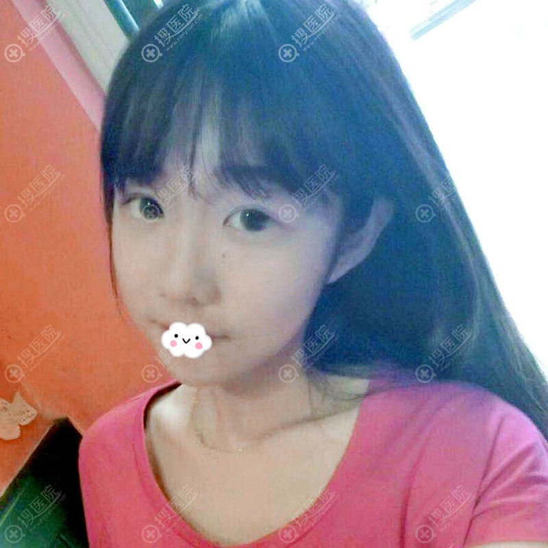 在成都西区医院做过隆鼻价格与效果成正比,又找车红昌割双眼皮