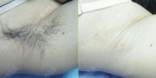 广州荔医冰点脱毛前后效果对比图 广州荔医冰点脱毛前后效果对比图