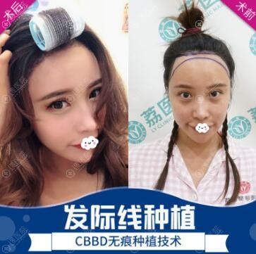 广州荔医发际线种植效果对比图 广州荔医发际线种植效果对比图