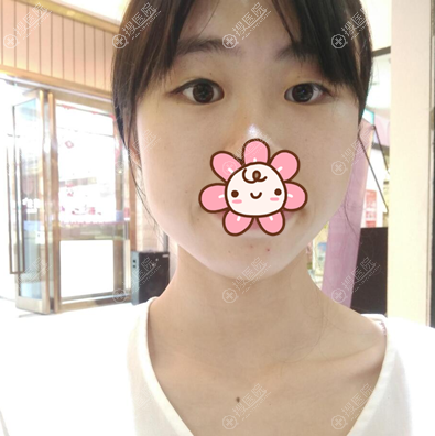 虽然男票不同意,但我还是找佛山梦露孙文娜做了双眼皮开眼角