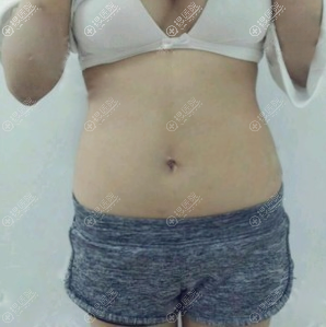 公开我去南京美贝尔找黄名斗做腰腹吸脂的亲身经历和恢复过程