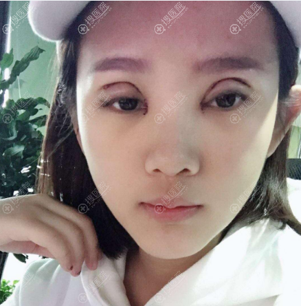 找了很久终于在重庆华美整形医院找到曹仁昌做了双眼皮失败修复