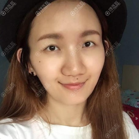和朋友一起来到北京悦丽汇医美,她割双眼皮我做隆鼻和脂肪填充