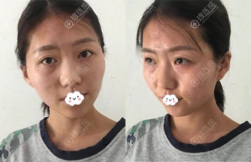 四川成都晶肤董薇薇院长不开刀降低颧骨颧弓整形改变我脸部轮廓
