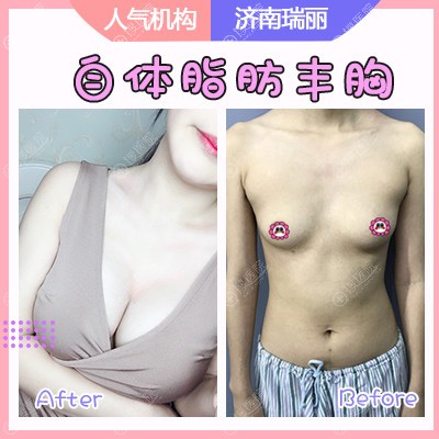 济南丰胸哪家好?公布济南排名前5的医院及医生隆胸案例价格表