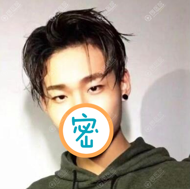 青岛伊美尔杨文国双眼皮案例反馈:男生也有爱美的权利