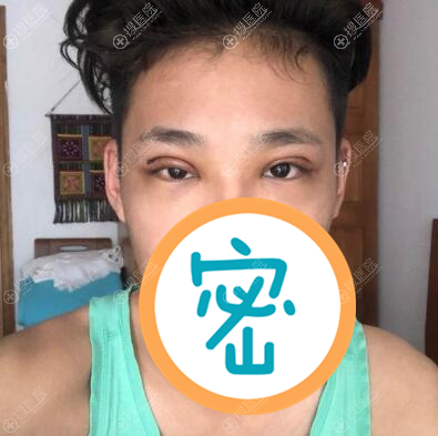 切开双眼皮术后5天照片 切开双眼皮术后5天照片