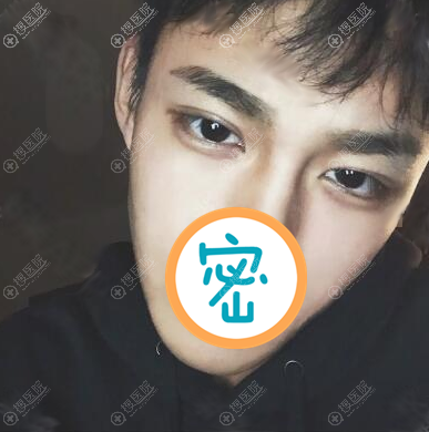 <!--<i data=20240710 data-id=12077></i>-->杨文国双眼皮术后效果 <!--<i data=20240710 data-id=12077></i>-->杨文国双眼皮术后效果