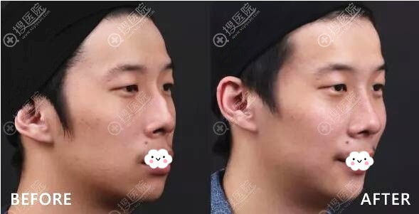 兰州皙妍丽鼻综合隆鼻案例效果对比图 兰州皙妍丽鼻综合隆鼻案例效果对比图