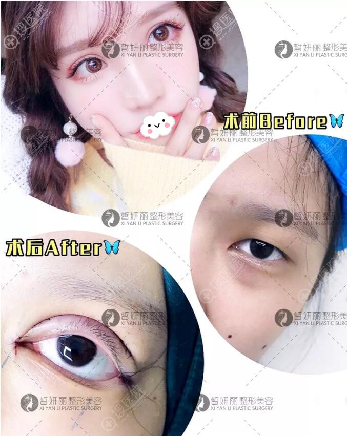 兰州皙妍丽双眼皮+开眼角案例效果对比图 兰州皙妍丽双眼皮+开眼角案例效果对比图
