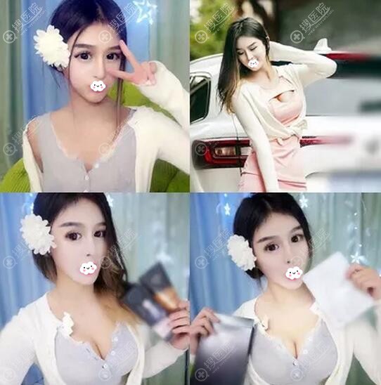 兰州皙妍丽假体隆胸案例效果前后对比图 兰州皙妍丽假体隆胸案例效果前后对比图