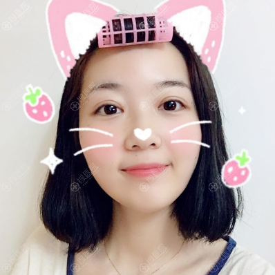 <!--<i data=20240710 data-id=10206></i>-->连天美盛飞医生做的双眼皮案例 <!--<i data=20240710 data-id=10206></i>-->连天美盛飞医生做的双眼皮案例