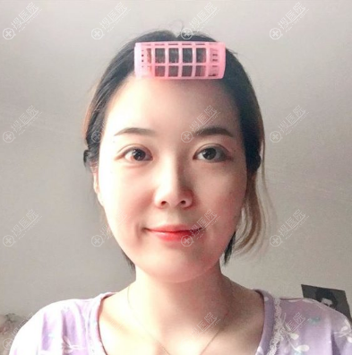 <!--<i data=20240710 data-id=10206></i>-->连天美盛飞做双眼皮怎么样 <!--<i data=20240710 data-id=10206></i>-->连天美盛飞做双眼皮怎么样