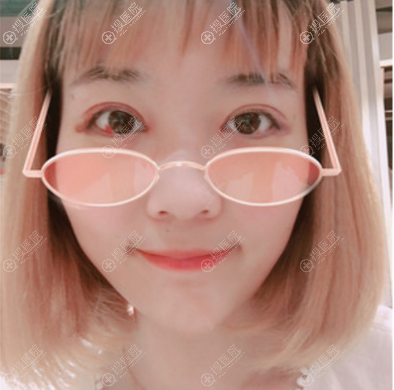 <!--<i data=20240710 data-id=10206></i>-->连天美盛飞眼综合拆线效果图 <!--<i data=20240710 data-id=10206></i>-->连天美盛飞眼综合拆线效果图