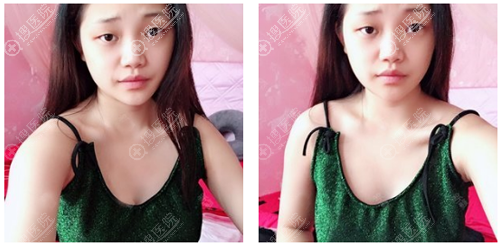 找重庆军美胡金香做自体脂肪隆胸半年了,脂肪存活率还是蛮高的