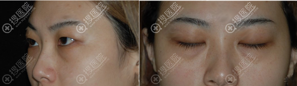 术前单眼皮肿泡眼眼袋明显 术前单眼皮肿泡眼眼袋明显