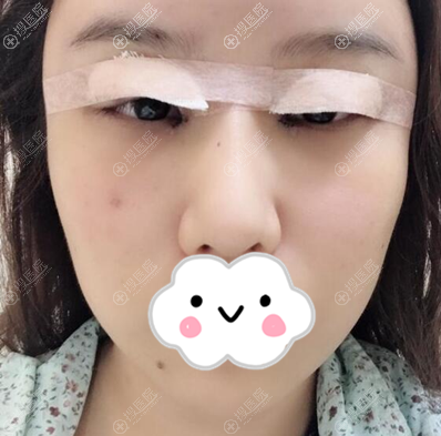 双眼皮+去眼袋术后即刻 双眼皮+去眼袋术后即刻