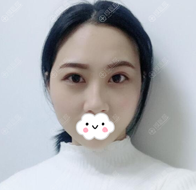 <!--<i data=20240710 data-id=12014></i>-->裴菁双眼皮半个月反馈 <!--<i data=20240710 data-id=12014></i>-->裴菁双眼皮半个月反馈