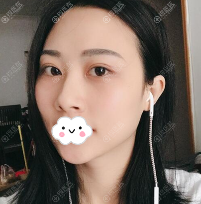 裴菁切开双眼皮+外切去眼袋术后一个月 裴菁切开双眼皮+外切去眼袋术后一个月