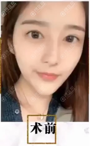 <!--<i data=20240710 data-id=9422></i>-->整形做双眼皮前 <!--<i data=20240710 data-id=9422></i>-->整形做双眼皮前
