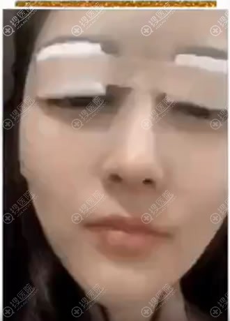 看朋友在南通伊莱美做双眼皮效果后,索性也找张兢院长割双眼皮