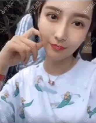 <!--<i data=20240710 data-id=9422></i>-->全切双眼皮案例 <!--<i data=20240710 data-id=9422></i>-->全切双眼皮案例