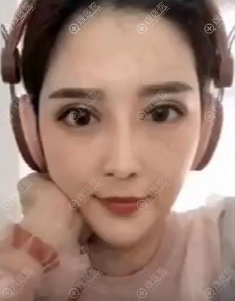 <!--<i data=20240710 data-id=9422></i>-->做双眼皮案例效果 <!--<i data=20240710 data-id=9422></i>-->做双眼皮案例效果