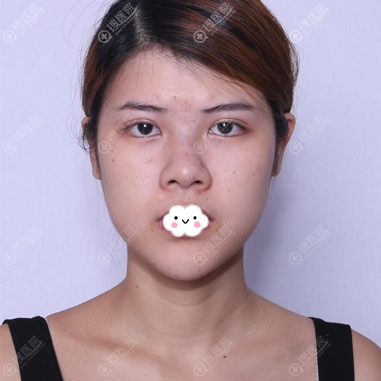 注射隆鼻失败论口碑找广州曙光蒋思军做复合耳软骨隆鼻修复案例