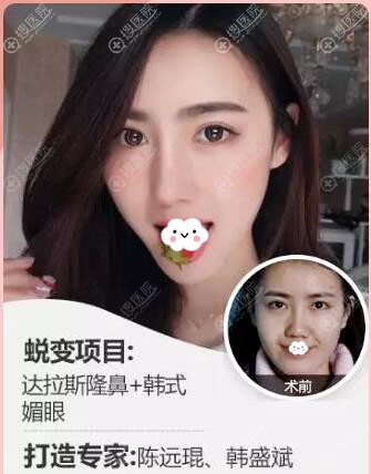 贵阳华美整形医院达拉斯隆鼻+韩式媚眼案例效果对比图 贵阳华美整形医院达拉斯隆鼻+韩式媚眼案例效果对比图