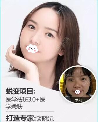 贵阳华美整形医院李前伟激光祛斑效果对比 贵阳华美整形医院李前伟激光祛斑效果对比
