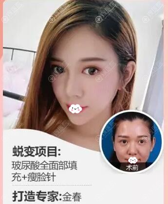 贵阳华美整形医院金春玻尿酸全面填充+案例对比图 贵阳华美整形医院金春玻尿酸全面填充+案例对比图