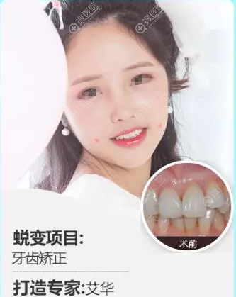 贵阳华美整形医院艾华牙齿矫正案例前后效果对比图 贵阳华美整形医院艾华牙齿矫正案例前后效果对比图