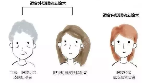 内切祛眼袋和外切去眼袋适合人群 内切祛眼袋和外切去眼袋适合人群