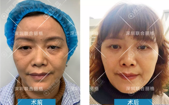<!--<i data=20240710 data-id=12014></i>-->祛眼袋术前术后对比 <!--<i data=20240710 data-id=12014></i>-->祛眼袋术前术后对比