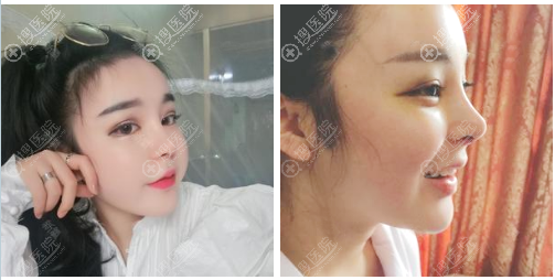 南京维多利亚李志生隆鼻修复术后八天 南京维多利亚李志生隆鼻修复术后八天