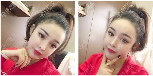 南京维多利亚李志生做的隆鼻修复案例 南京维多利亚李志生做的隆鼻修复案例