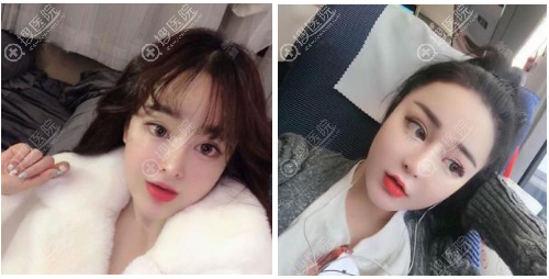 南京维多利亚李志生做隆鼻怎么样 南京维多利亚李志生做隆鼻怎么样