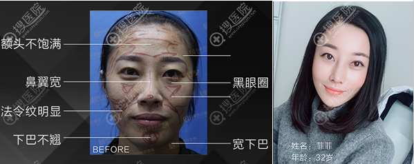 <!--<i data=20240710 data-id=11933></i>-->高卿豪达拉斯隆鼻+面部脂肪填充案例 <!--<i data=20240710 data-id=11933></i>-->高卿豪达拉斯隆鼻+面部脂肪填充案例
