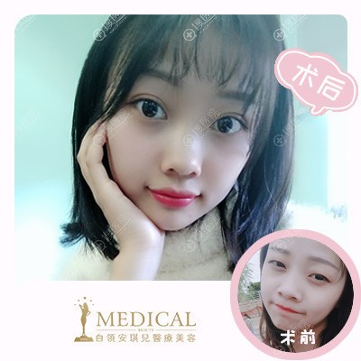 合肥安琪儿医院整形科胡准院长双眼皮案例 合肥安琪儿医院整形科胡准院长双眼皮案例