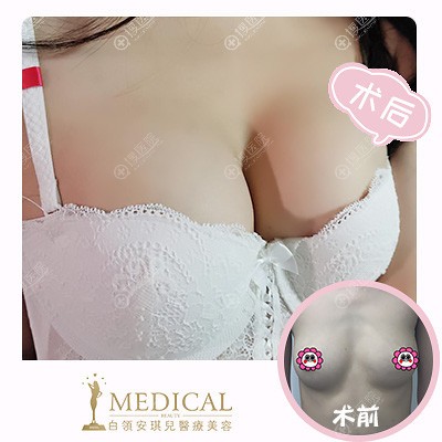 合肥白领安琪儿医院隆胸怎么样 合肥白领安琪儿医院隆胸怎么样