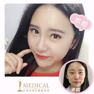 合肥安琪儿医院胡准脂肪填充案例 合肥安琪儿医院胡准脂肪填充案例
