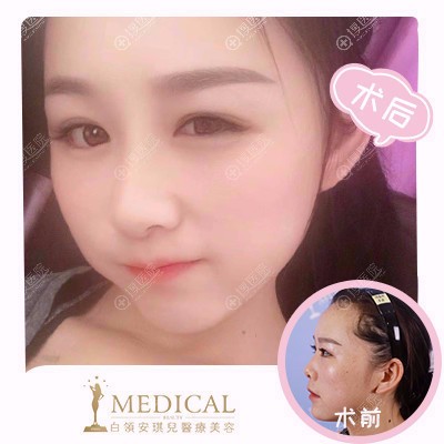 合肥白领安琪儿<!--<i data=20240710 data-id=1798></i>-->胡准隆鼻案例 合肥白领安琪儿<!--<i data=20240710 data-id=1798></i>-->胡准隆鼻案例