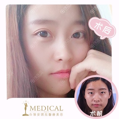 合肥白领安琪儿医院胡准做的双眼皮案例 合肥白领安琪儿医院胡准做的双眼皮案例