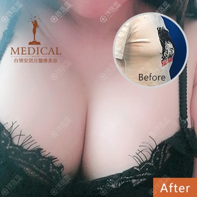 合肥安琪儿医院胡准做的隆胸案例 合肥安琪儿医院胡准做的隆胸案例